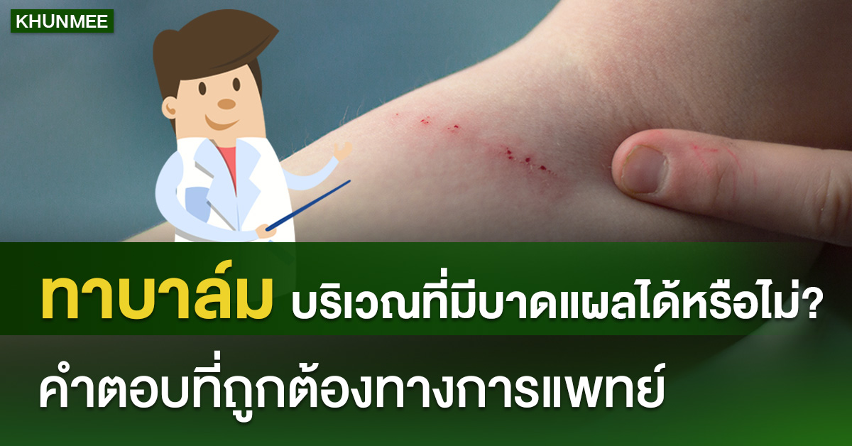 ทาบาล์มบริเวณที่มีบาดแผลได้หรือไม่? คำตอบที่ถูกต้องทางการแพทย์