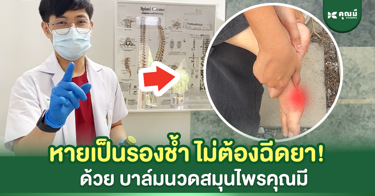 วิธีรักษารองช้ำโดยไม่ต้องฉีดยา ด้วยบาล์มนวดคุณมี